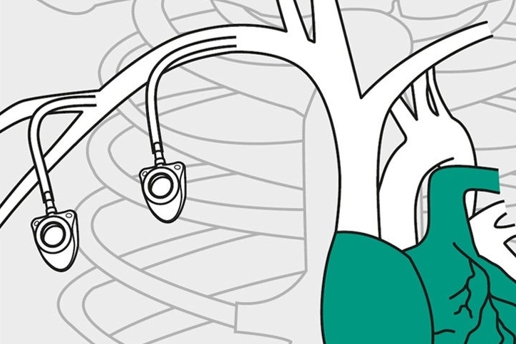 Vascular access port catheters and port needles